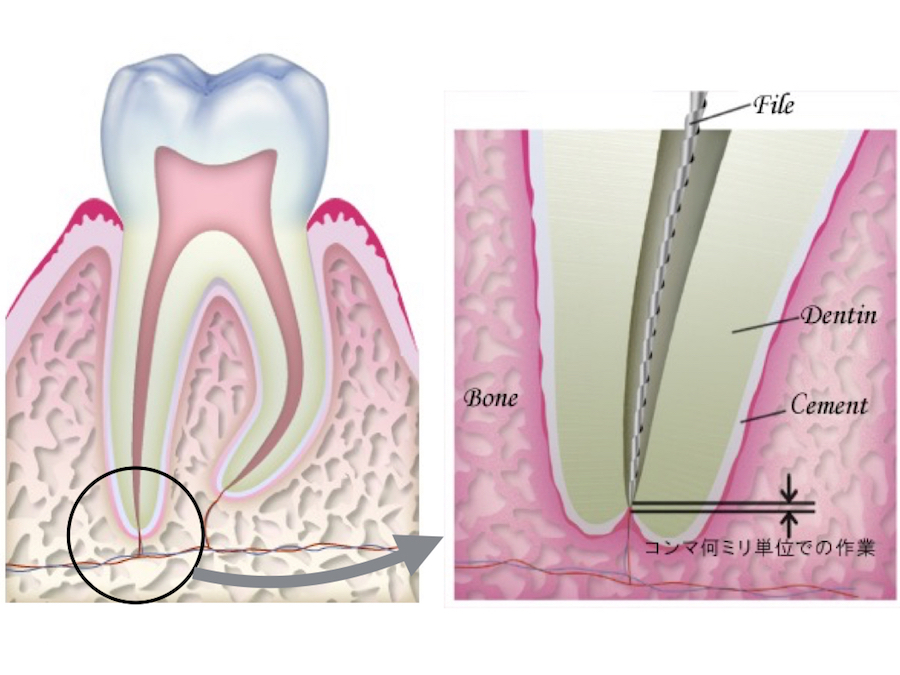 歯 の 神経 炎症